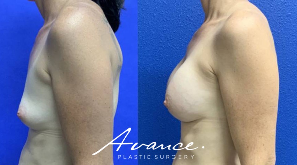 Before and After - Breast Augmentation