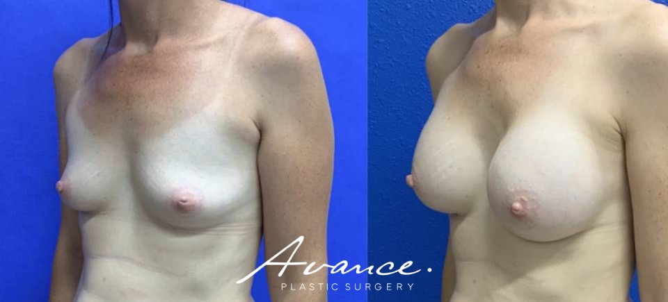 Before and After - Breast Augmentation