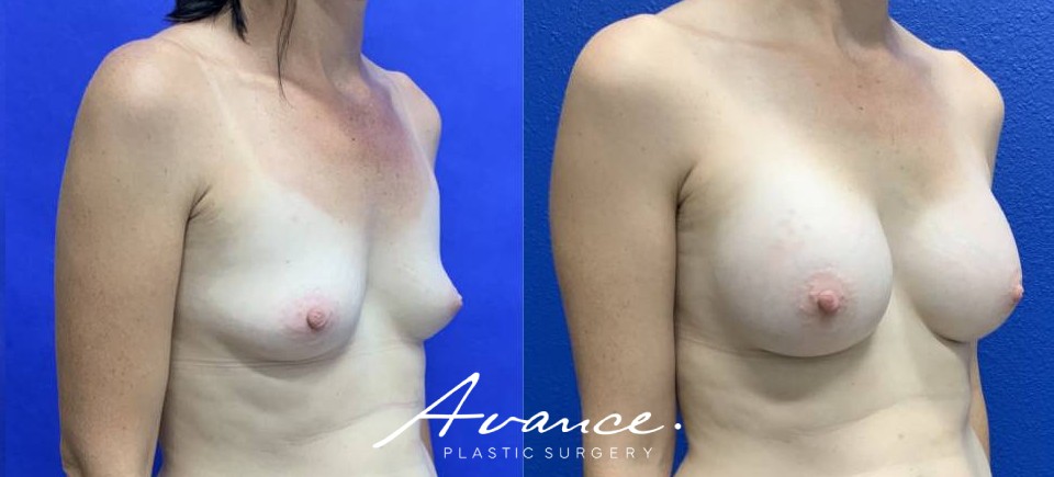 Before and After - Breast Augmentation
