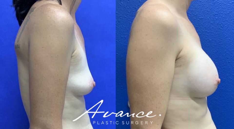 Before and After - Breast Augmentation