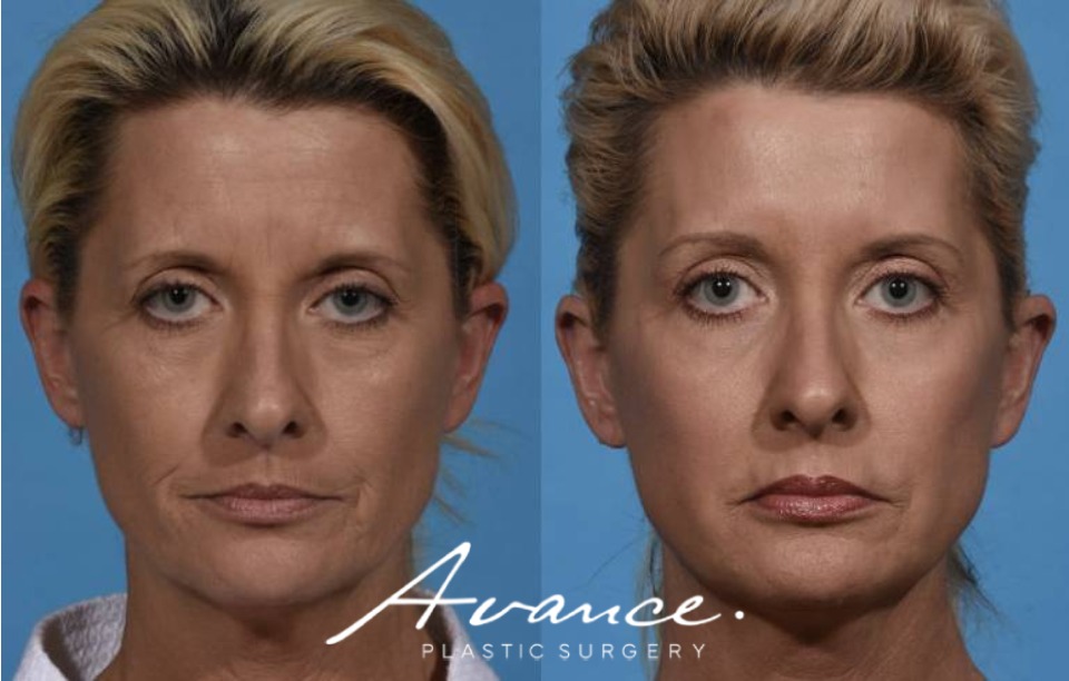 Before and After - Laser Resurfacing