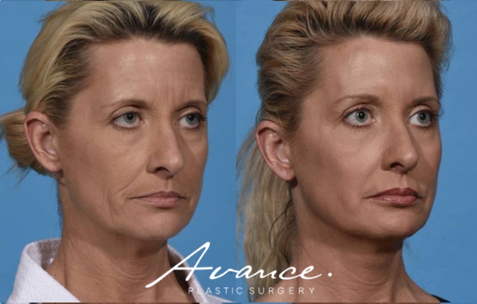 Before and After - Laser Resurfacing