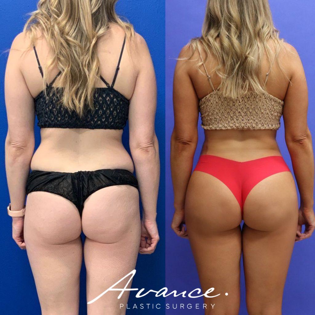 Before and After - Buttock