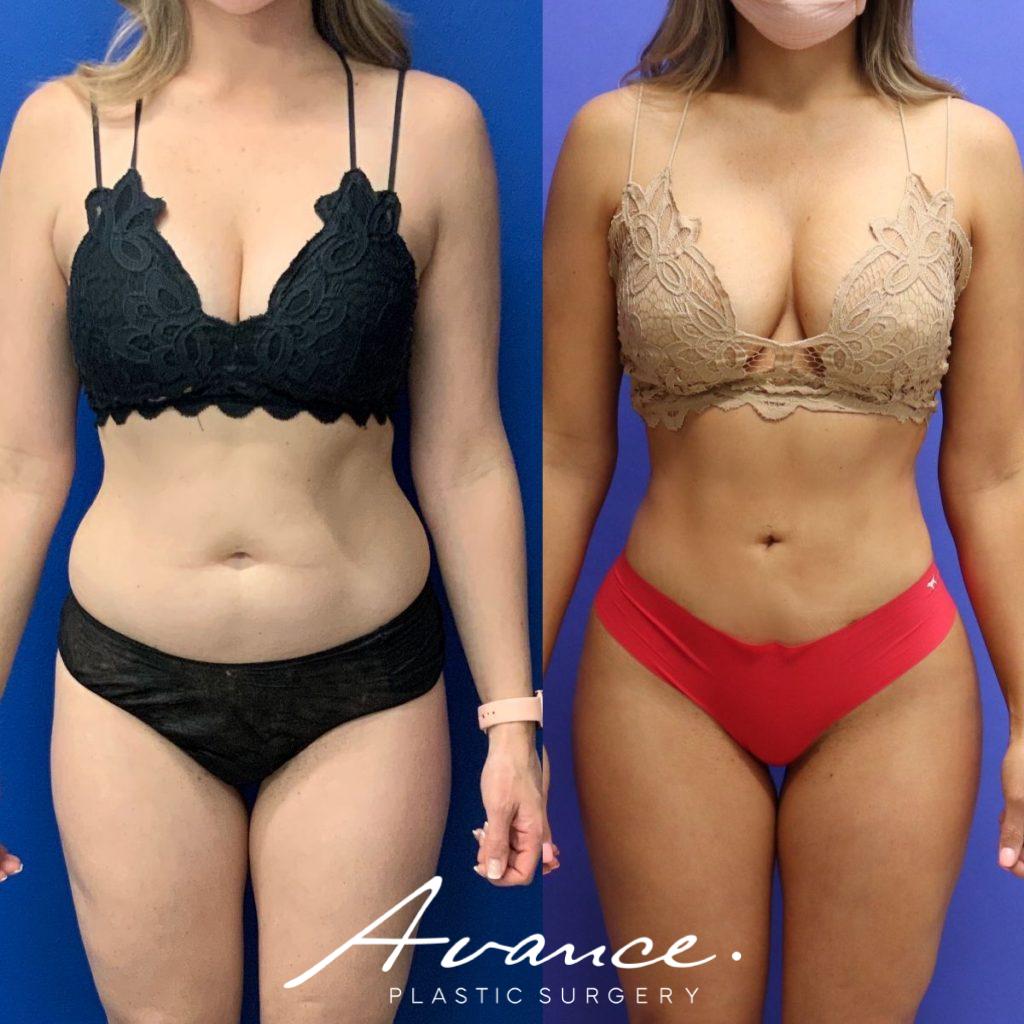 Before and After - Buttock
