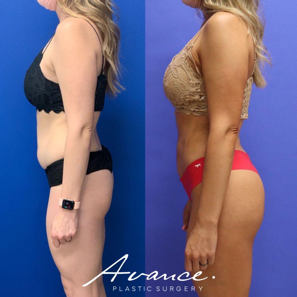 Before and After - Buttock