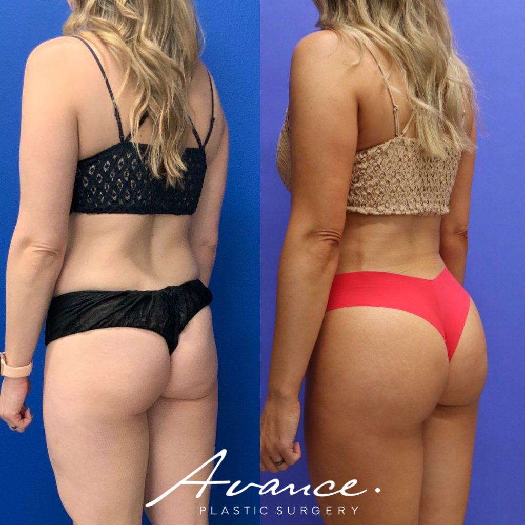Before and After - Buttock
