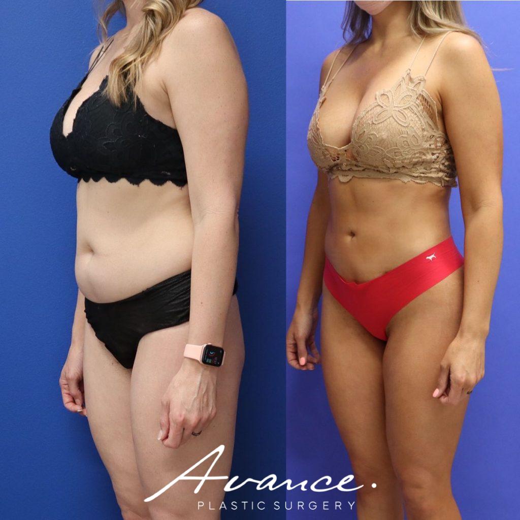 Before and After - Buttock