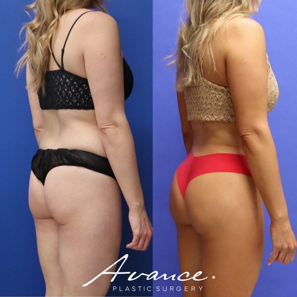 Before and After - Buttock