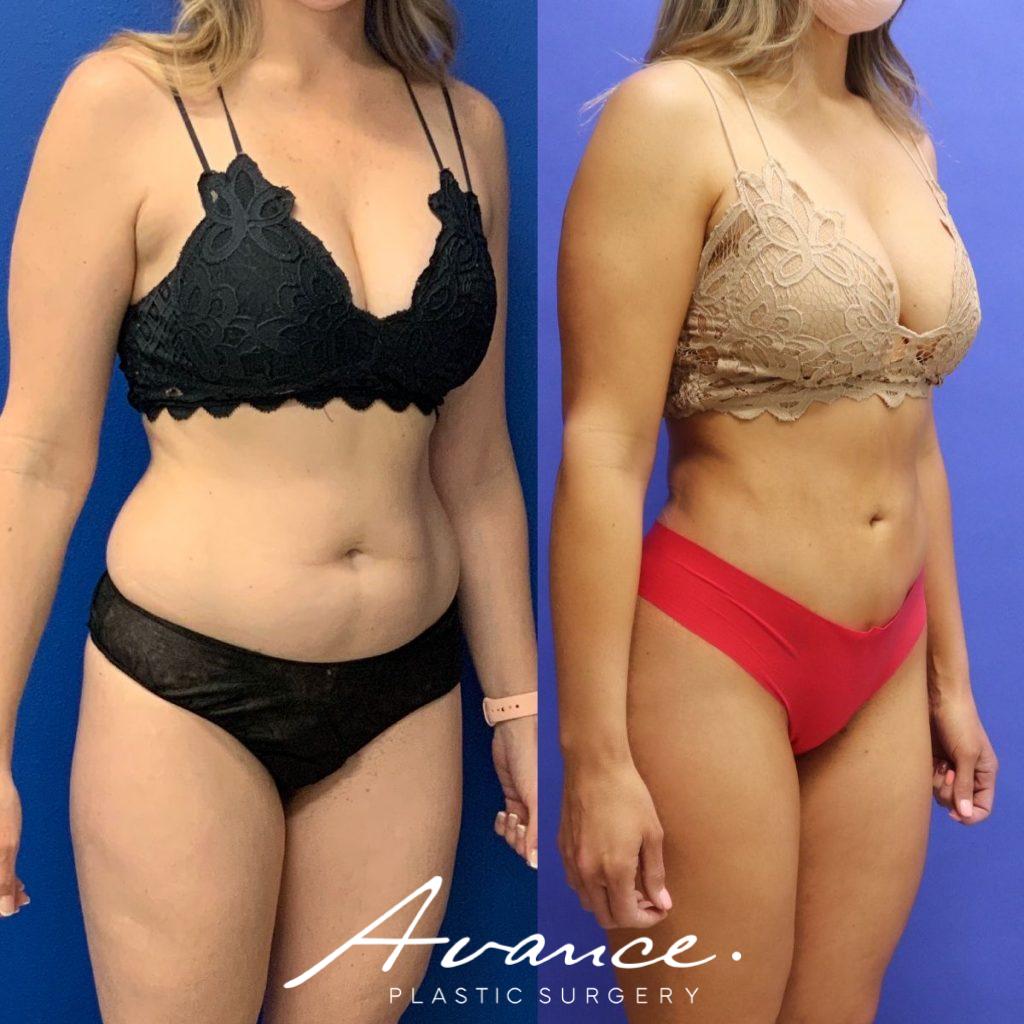 Before and After - Buttock