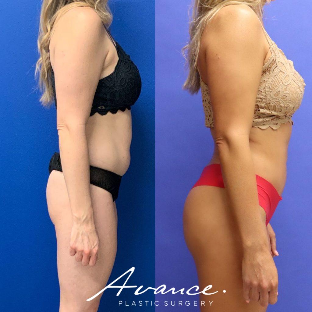 Before and After - Buttock