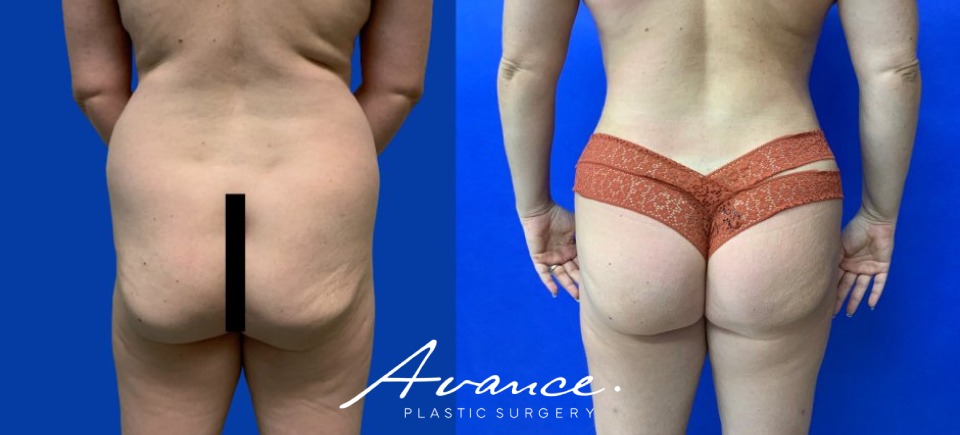 Before and After - Buttock