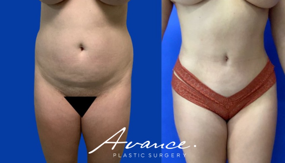 Before and After - Buttock