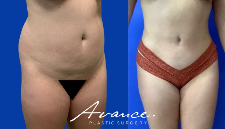 Before and After - Buttock