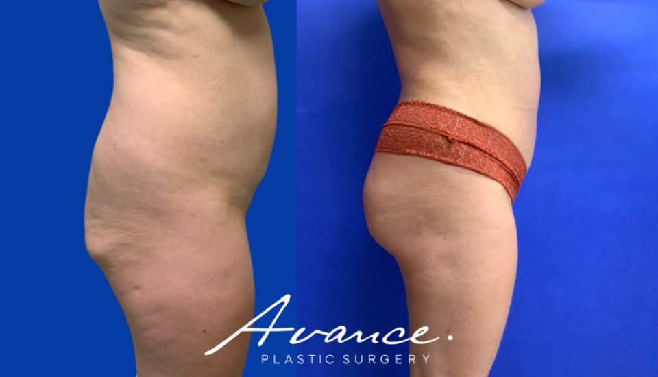 Before and After - Buttock