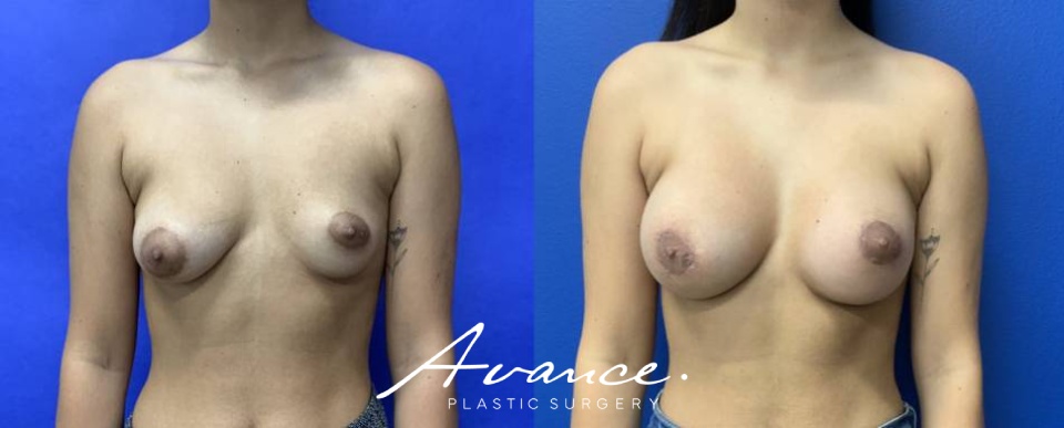 Before and After - Tuberous Breast