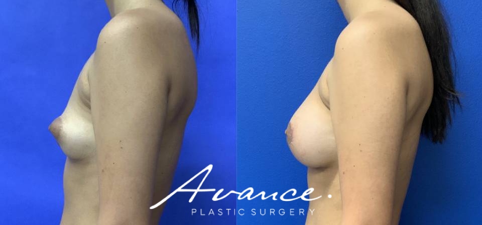 Before and After - Tuberous Breast