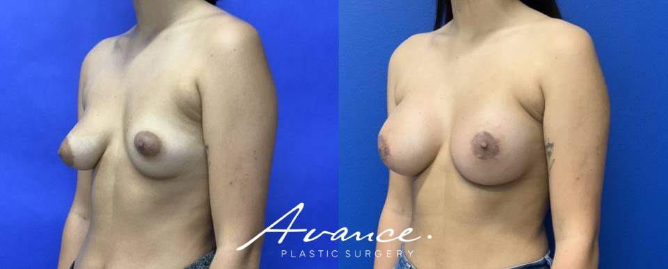 Before and After - Tuberous Breast