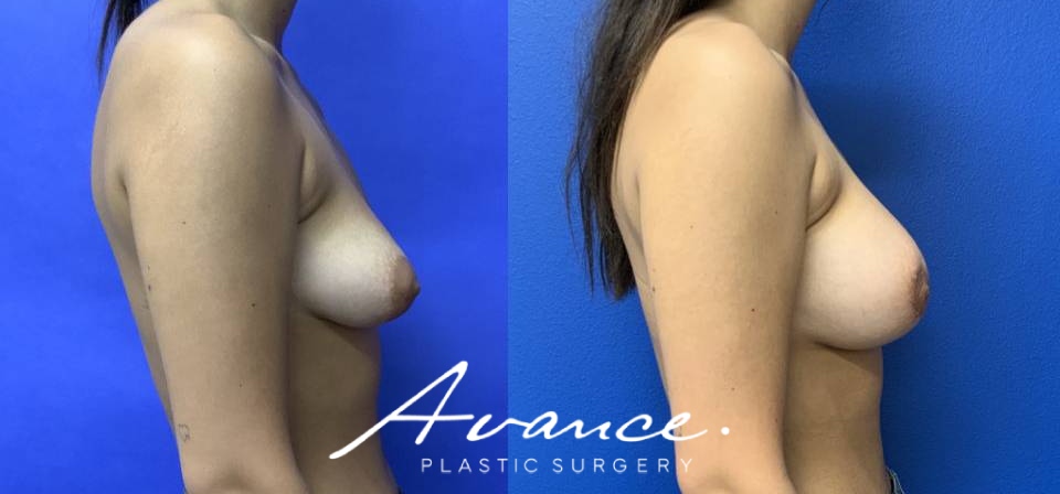 Before and After - Tuberous Breast