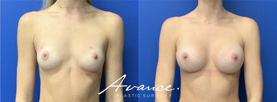 Before and After - Breast Augmentation