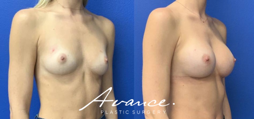 Before and After - Breast Augmentation