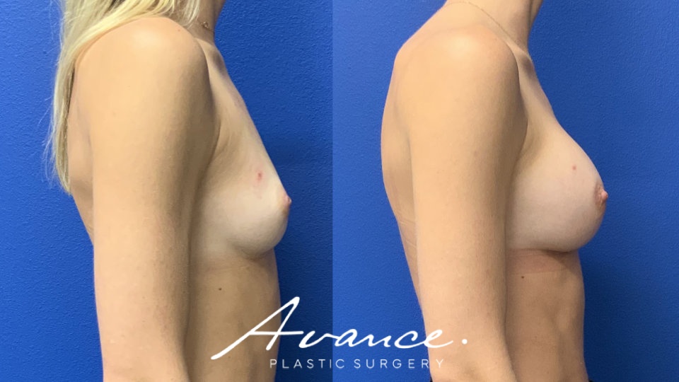 Before and After - Breast Augmentation