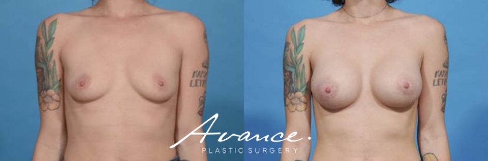 Before and After - Breast Augmentation