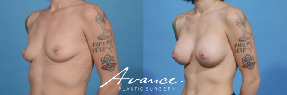 Before and After - Breast Augmentation