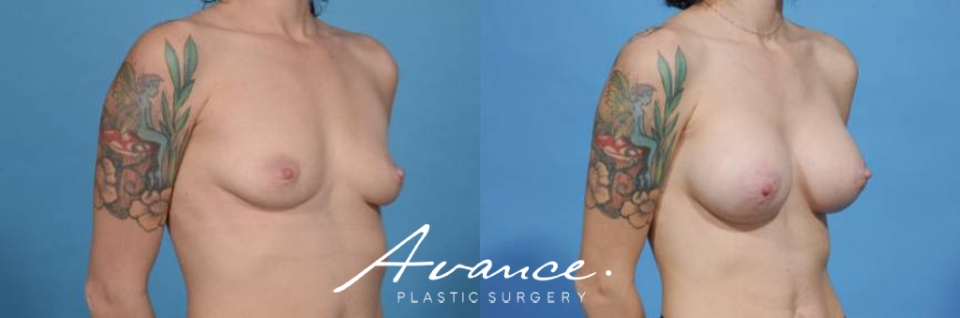Before and After - Breast Augmentation