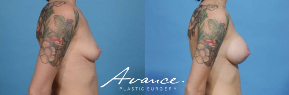 Before and After - Breast Augmentation