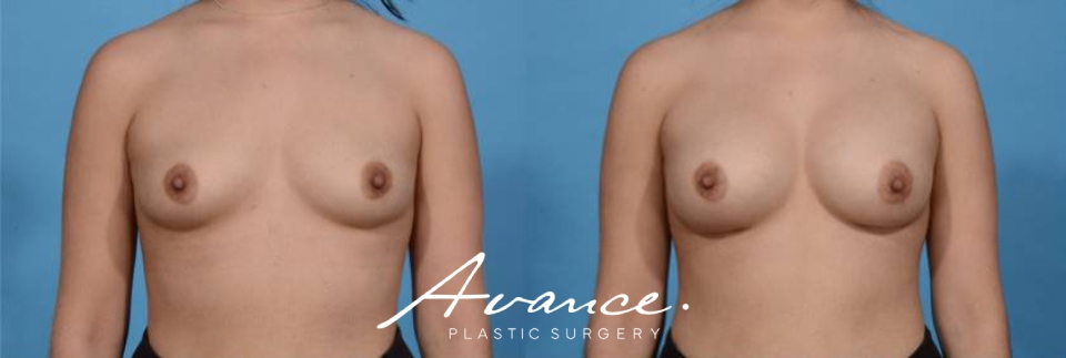 Before and After - Breast Augmentation