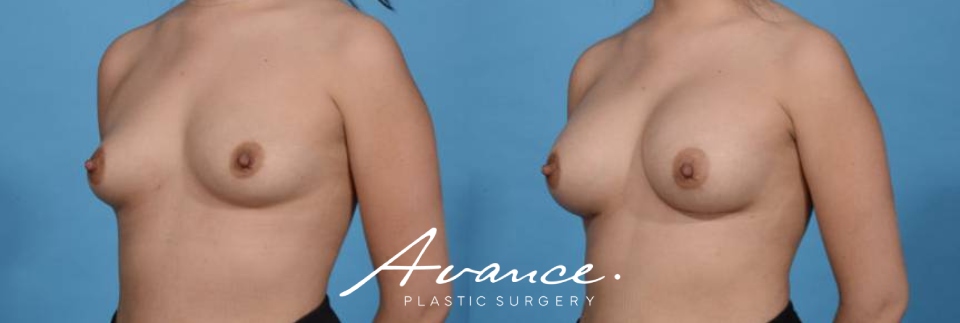Before and After - Breast Augmentation