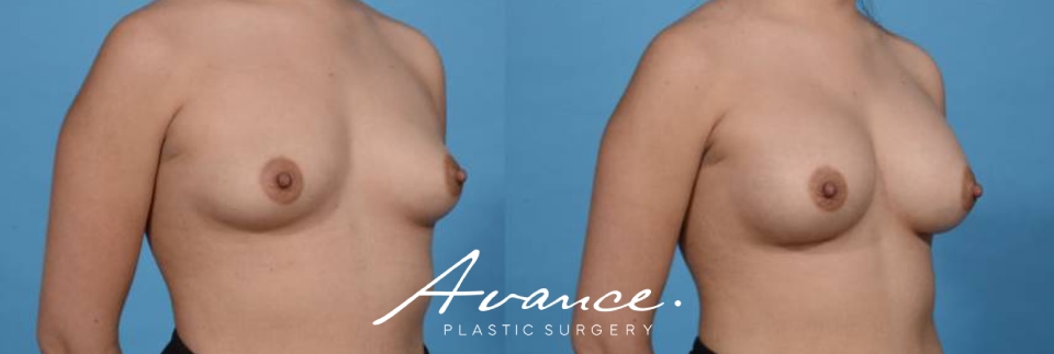 Before and After - Breast Augmentation