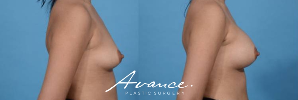 Before and After - Breast Augmentation