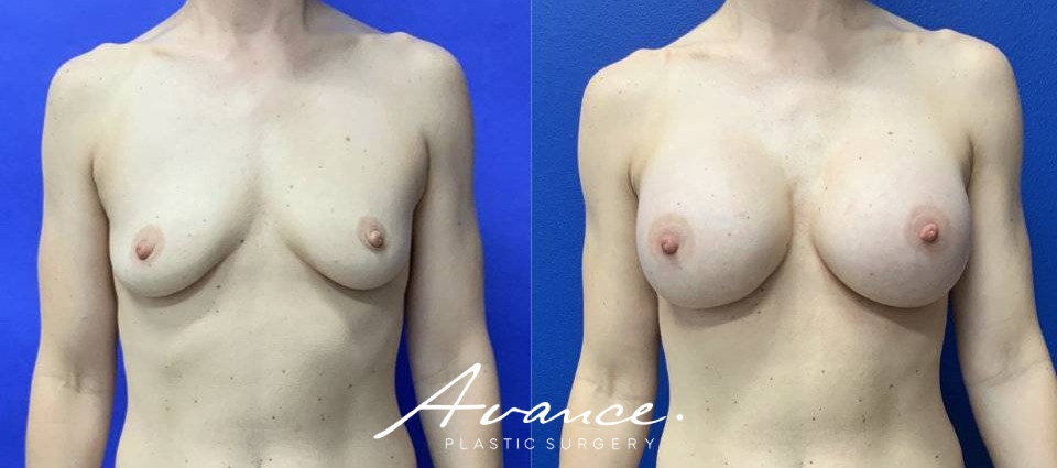 Before and After - Breast Augmentation