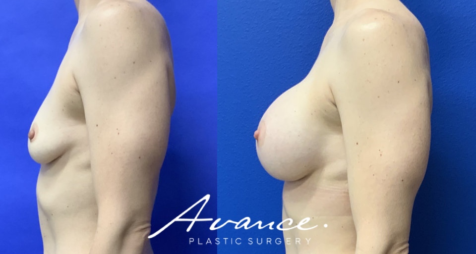 Before and After - Breast Augmentation