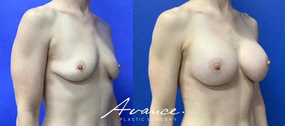 Before and After - Breast Augmentation