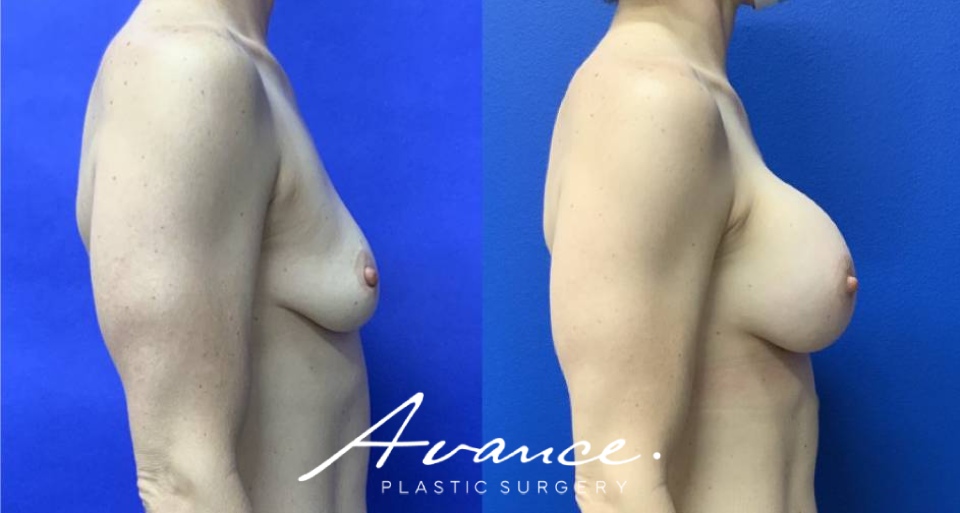Before and After - Breast Augmentation