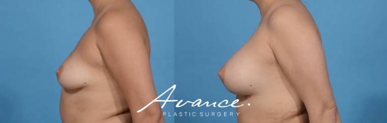 Before and After - Breast Augmentation
