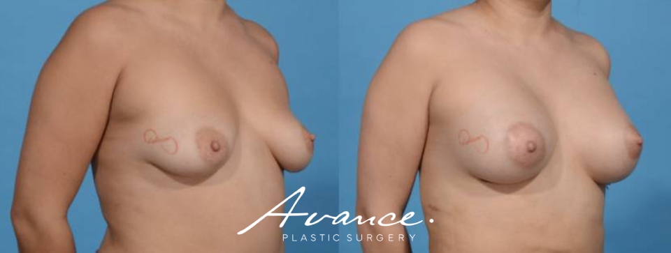 Before and After - Breast Augmentation