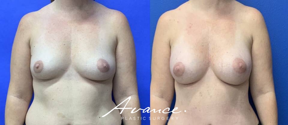 Before and After - Breast Augmentation