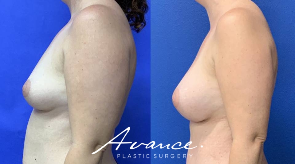 Before and After - Breast Augmentation