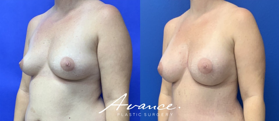 Before and After - Breast Augmentation
