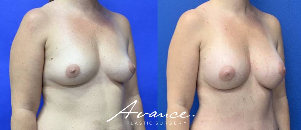 Before and After - Breast Augmentation