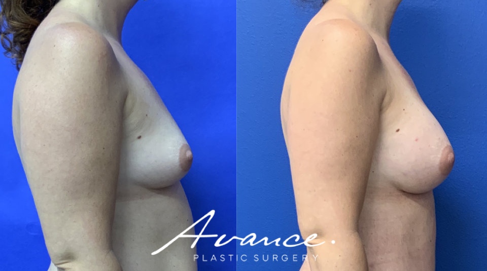 Before and After - Breast Augmentation