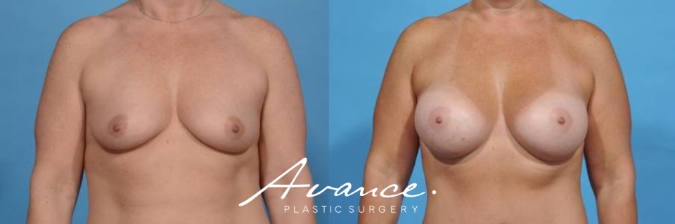Before and After - Breast Augmentation