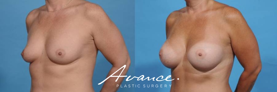 Before and After - Breast Augmentation
