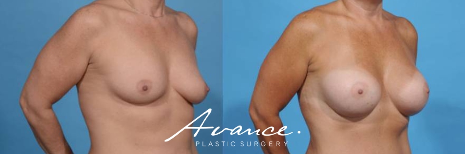 Before and After - Breast Augmentation
