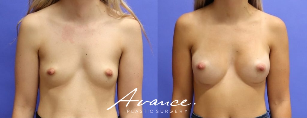 Before and After - Breast Augmentation