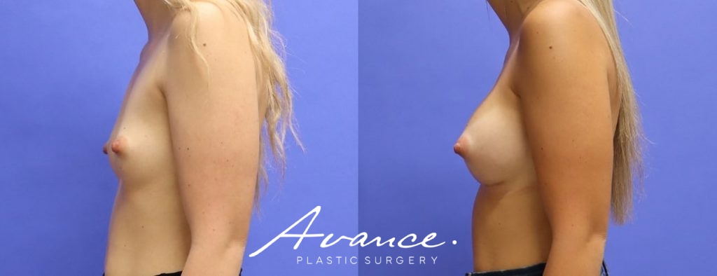 Before and After - Breast Augmentation