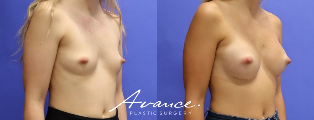 Before and After - Breast Augmentation